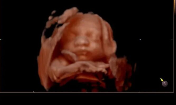 5D ultrasound image of a baby at Glimpse of Love